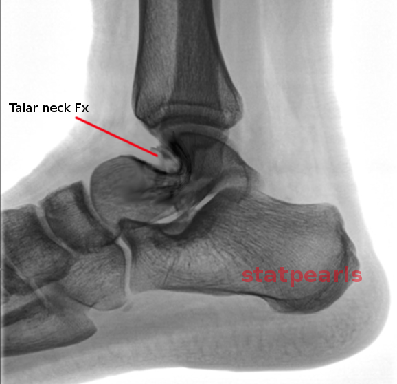 <p>Talar Neck Fracture</p>