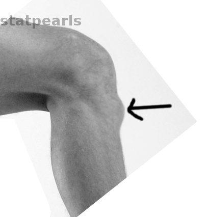 Osgood Schlatter disease