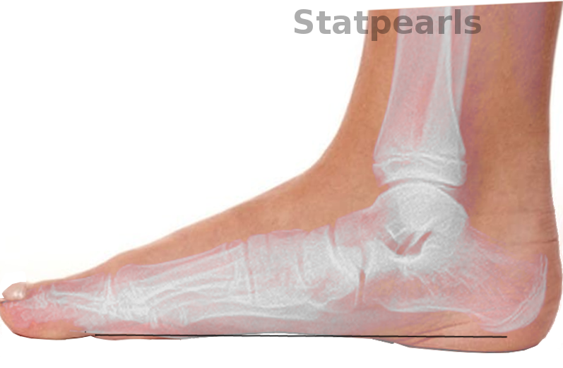 <p>Progressive Collapsing Foot Deformity