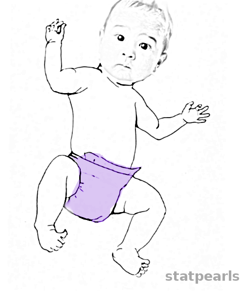 <p>Moro Reflex.</p>