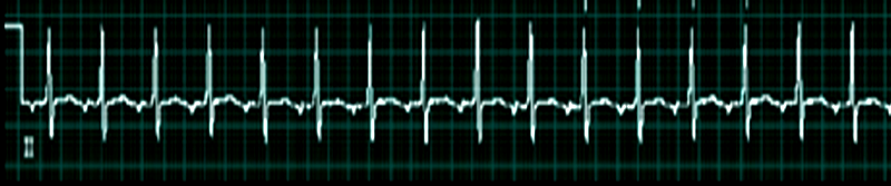 Atrial tachycardia