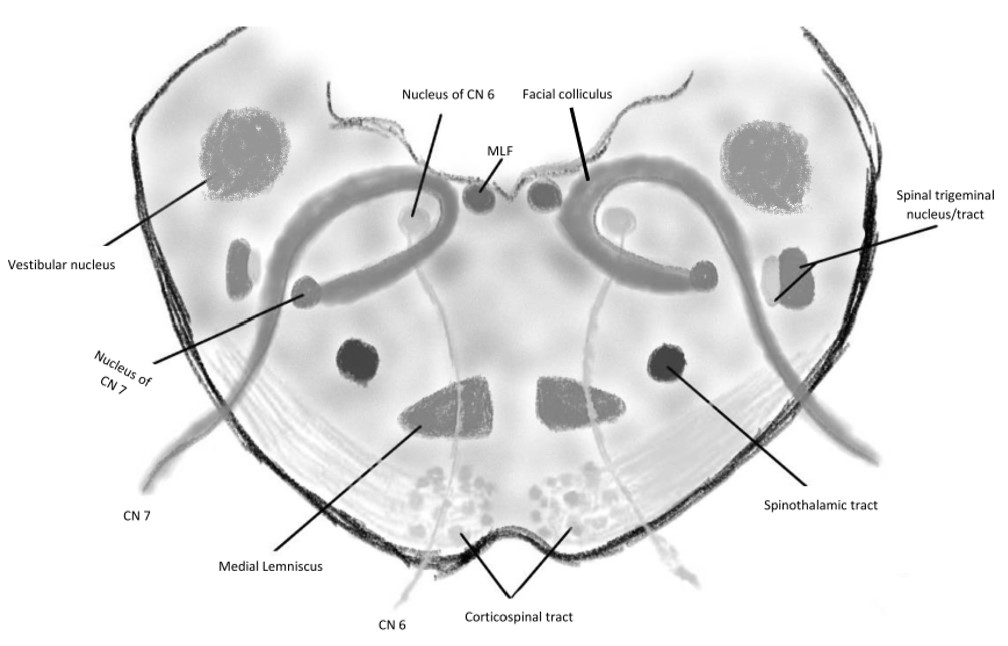 <p>Foville Syndrome Anatomy. The anatomy is shown at the level of the inferomedial pons.</p>