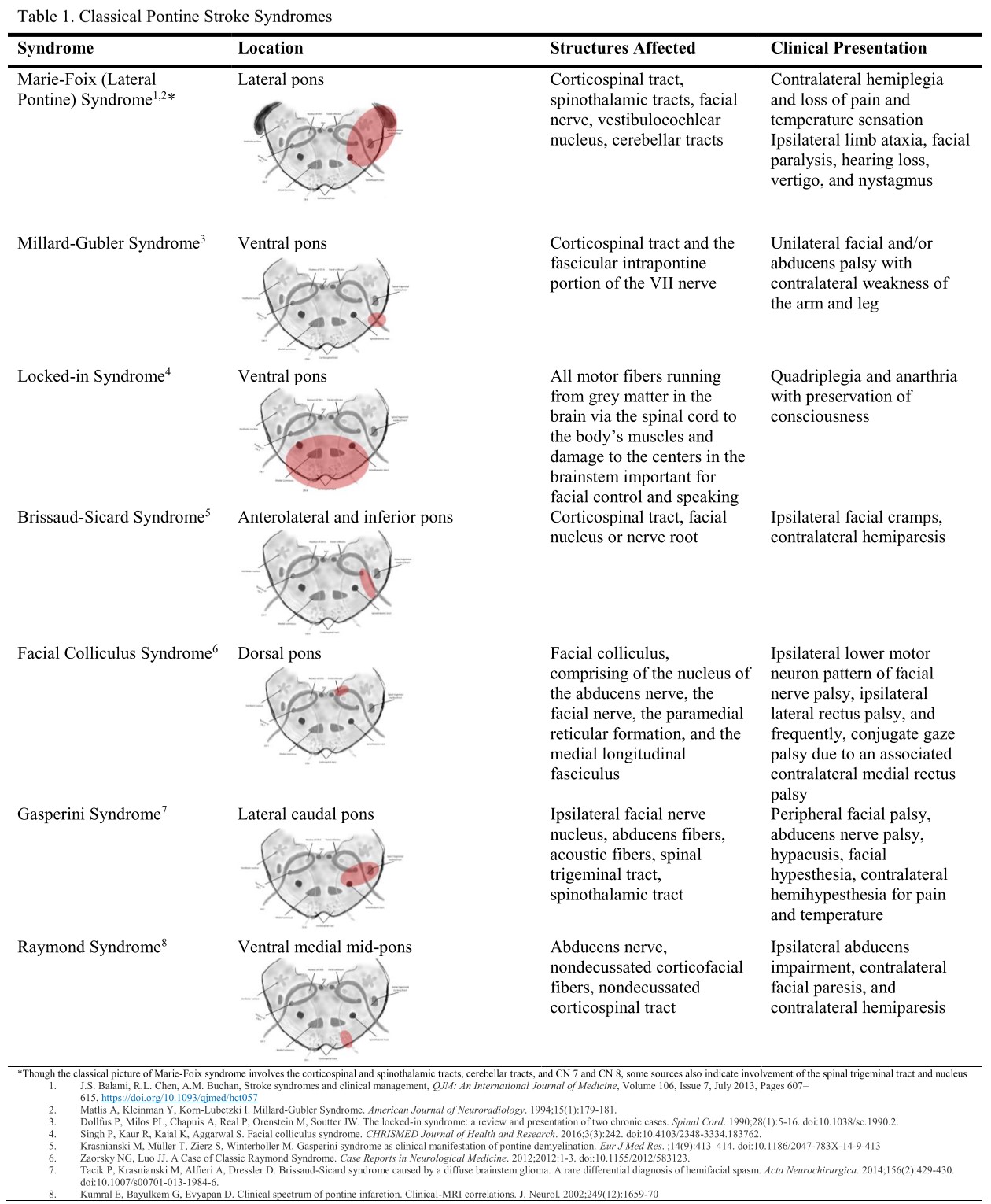 <p>Pontine Stroke Syndromes