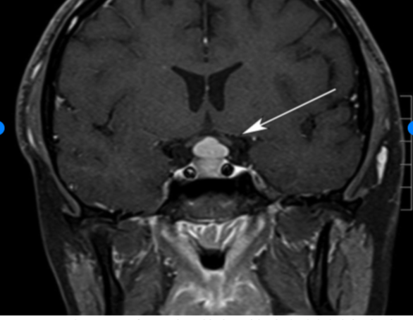 <p>&nbsp;Pituitary Hyperplasia. The hyperplasia is due to primary hypothyroidism.</p>