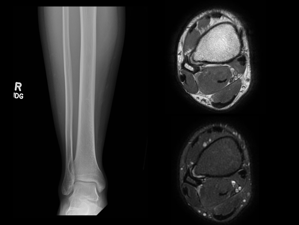 <p>Osteochondroma on AP Radiograph