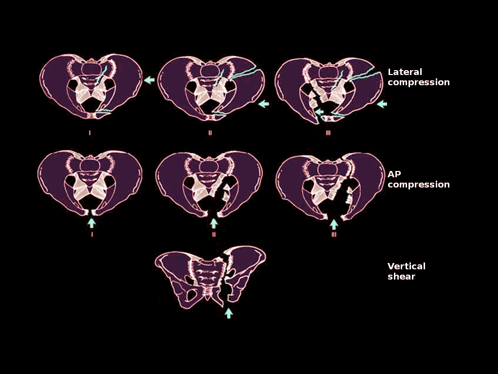 <p>Pelvic Ring Injuries. Pelvic ring injuries depicting lateral compression, AP compression, and vertical shear.</p>