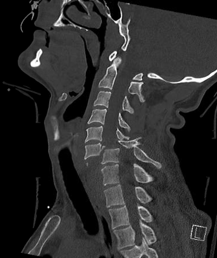 <p>Bilateral Facet Fracture Dislocation of the Cervical Spine</p>