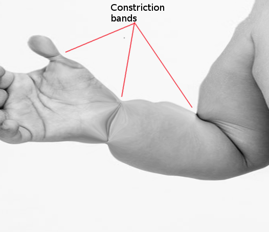 <p>Amniotic Band Syndrome. This image depicts 3 constriction bands on the arm, characteristic of amniotic band syndrome.</p>
