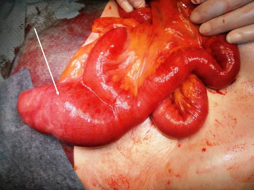 <p>Meckel Diverticulum. The&nbsp;image shows a Meckel diverticulum (white arrow).</p>