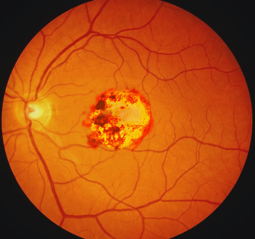 <p>Congenital Toxoplasmosis