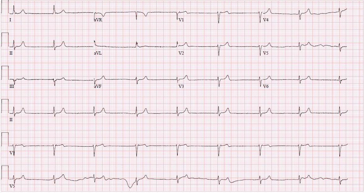 <p>Junctional Rhythm