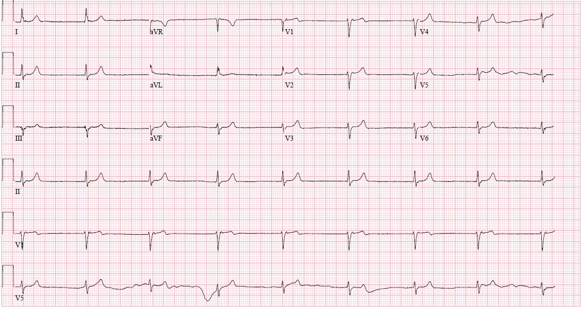 <p>Junctional Rhythm</p>