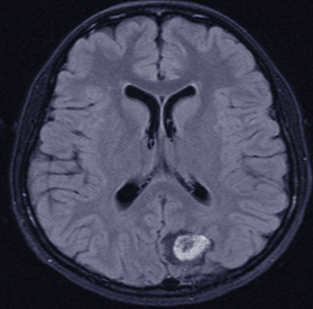 <p>Central Nervous System Lymphoma, MRI