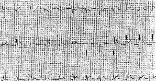 <p>Acute Pericarditis Findings, Electrocardiograph
