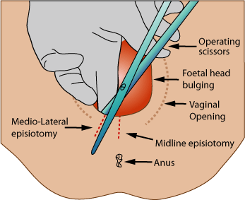 <p>Episiotomy. This image depicts the various types of episiotomy incisions.</p>