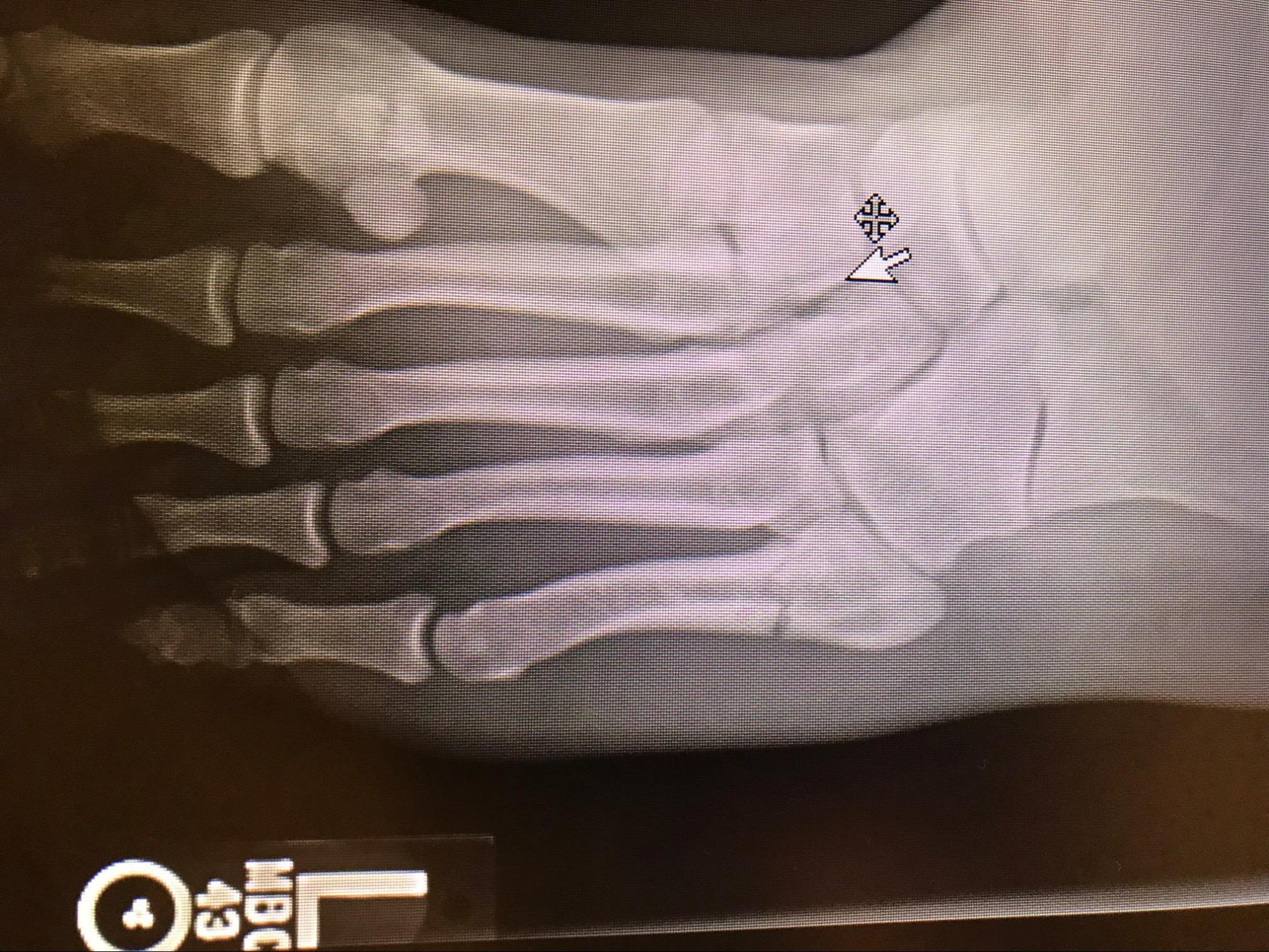 Jones Fracture
Classic appears of a Jones fracture of the 5th metatarsal meta-diaphyseal junction.