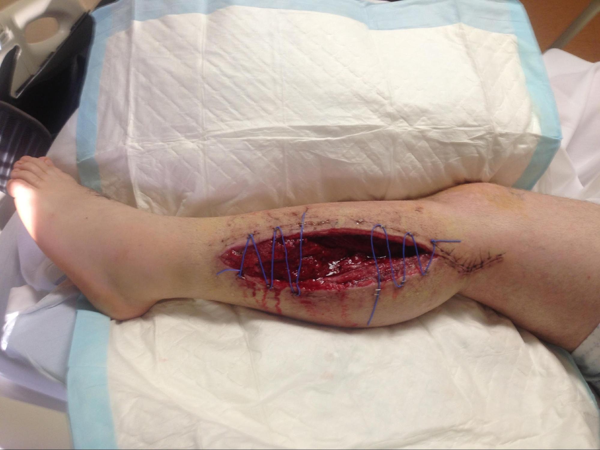 Acute Compartment Syndrome
Fasciotomy secondary to compartment syndrome of the deep leg compartment.