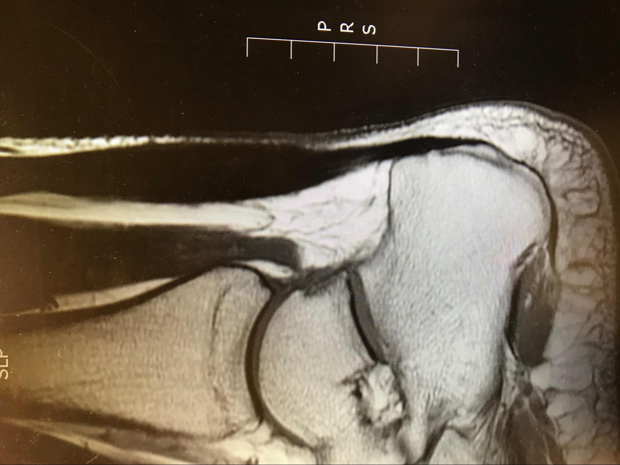 Achilles Tendonitis
T1 MRI demonstrating bulbous appearing Achilles tendon with homogenous signal.