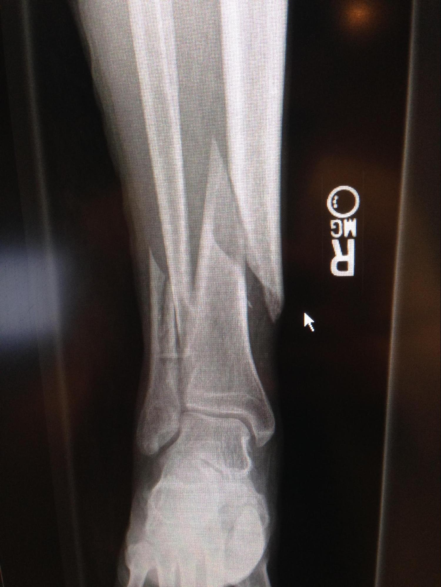 Tibial Fracture
Spiral fracture of the distal one-third tibia and fibula.