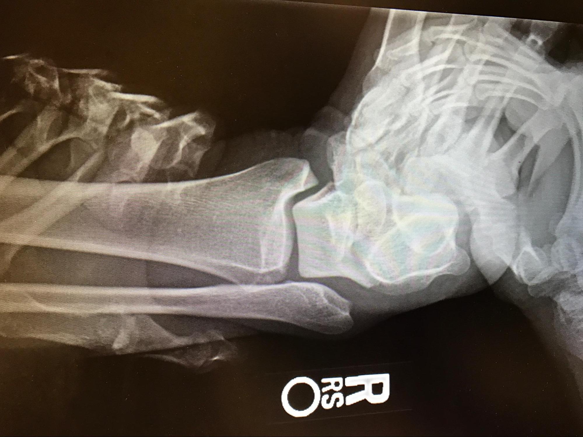 Acute Ankle Sprain
Grade 3 ankle sprain demonstrated by talar tilt test stress radiograph