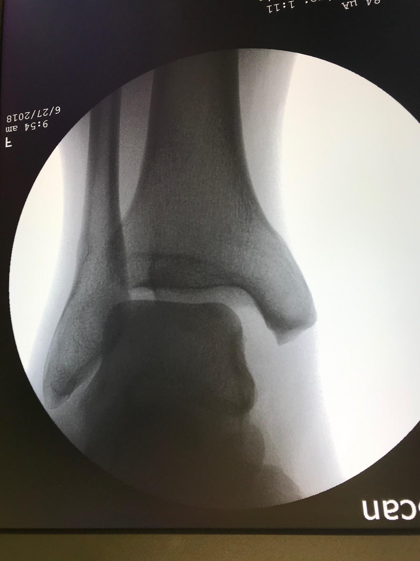 <p>Acute Ankle Sprain, Radiograph