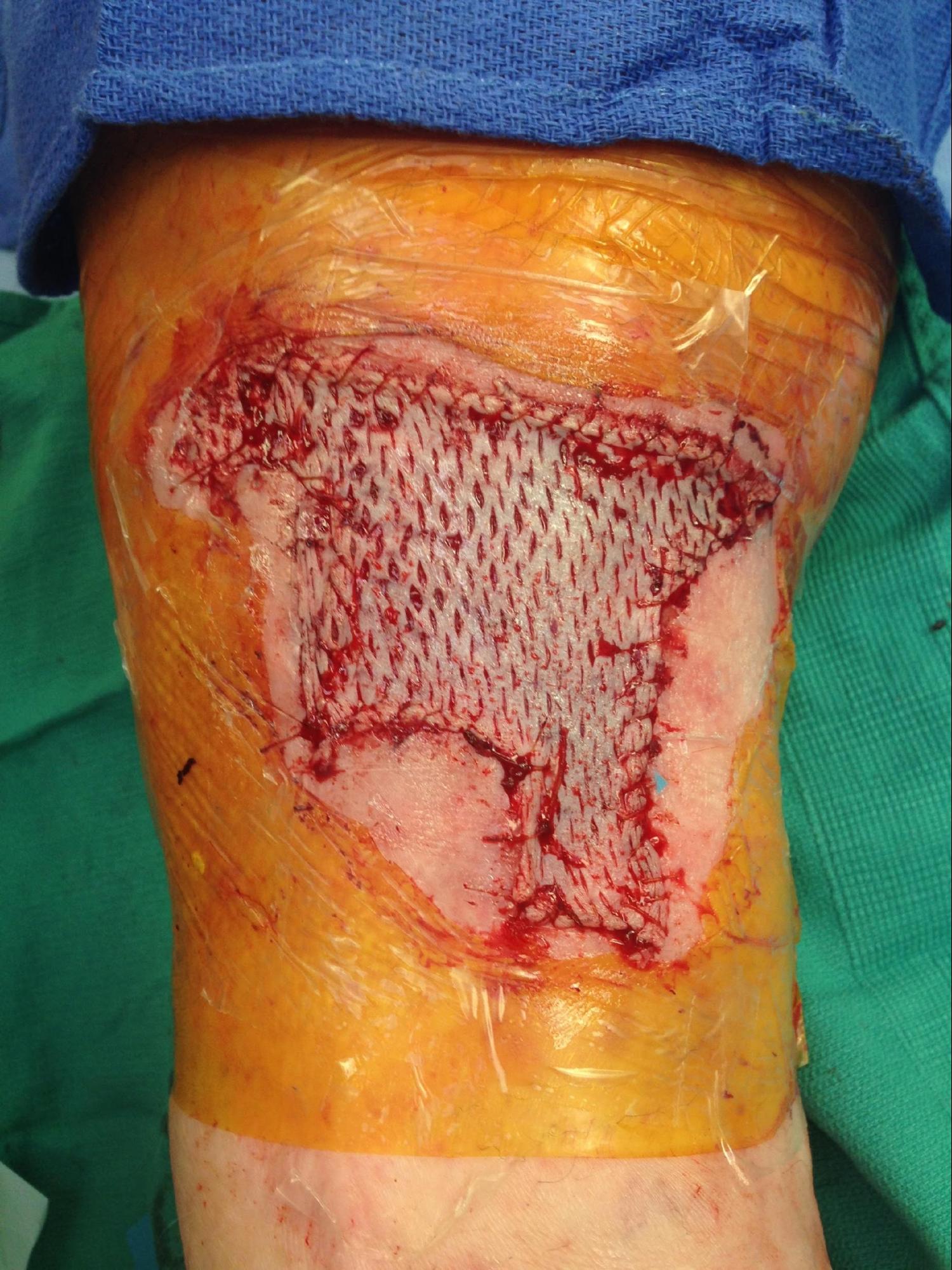 Skin Grafting 
Meshed split thickness skin graft to the leg.