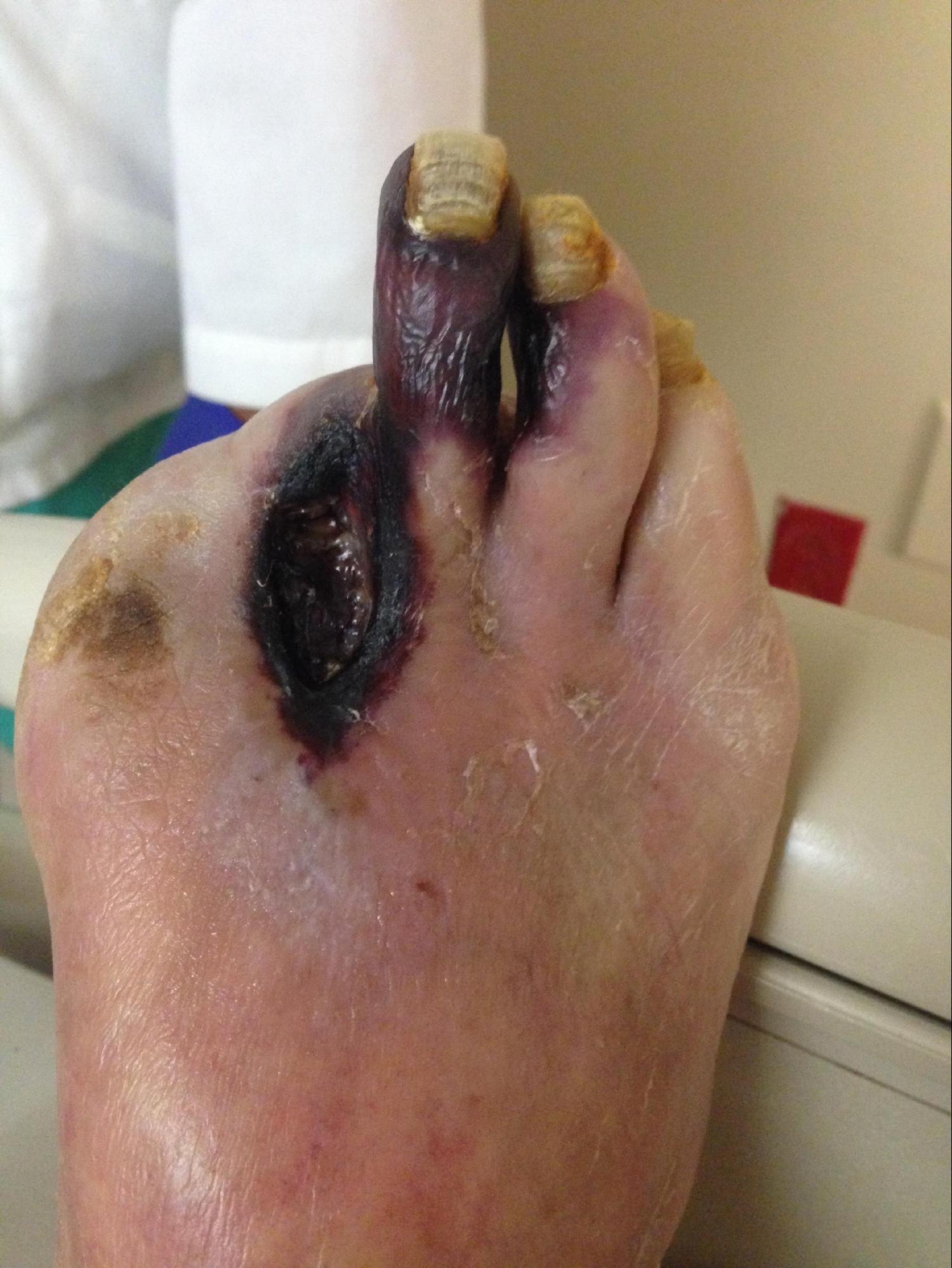 <p>Peripheral Arterial Disease With Gangrene of the Third Digit