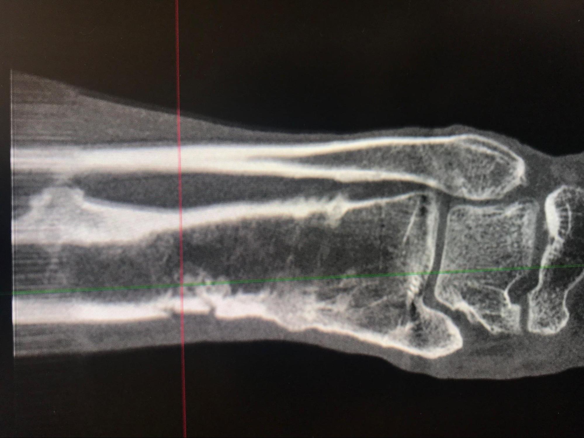 Osteomyelitis 
CT Scan of Chronic osteomyelitis of the leg demonstrating classic cloaca, sequestrum and involucrum