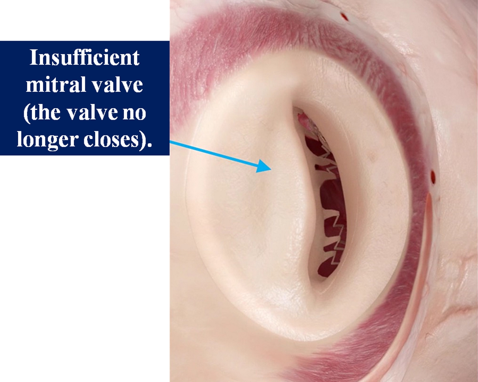 <p>Insufficient Mitral Valve. The valve no longer closes properly.</p>