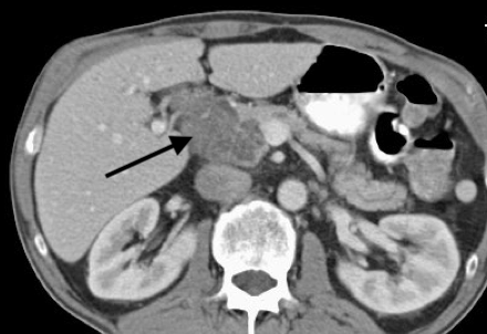 <p>Serous Cystadenoma, CT</p>