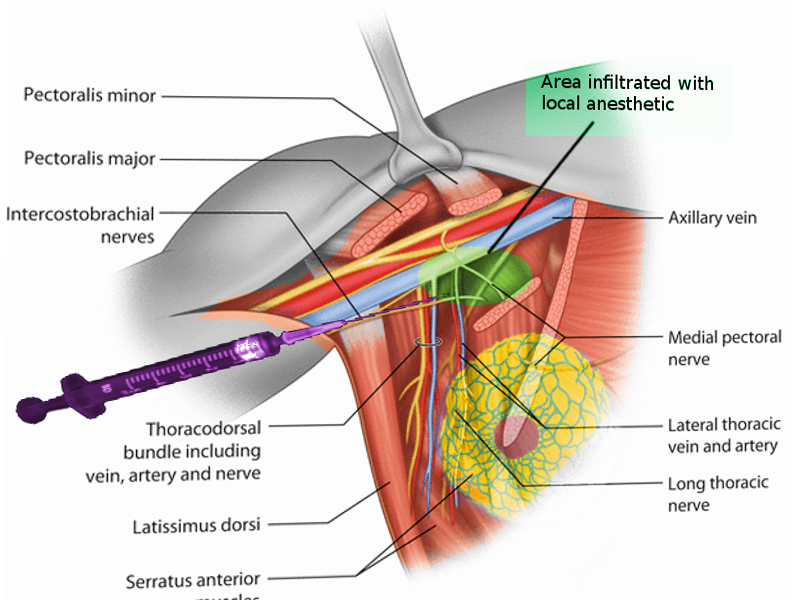 Pectoralis nerve block