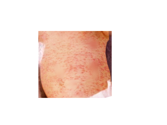 Erythema toxicum