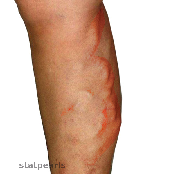 <p>Migratory Thrombophlebitis