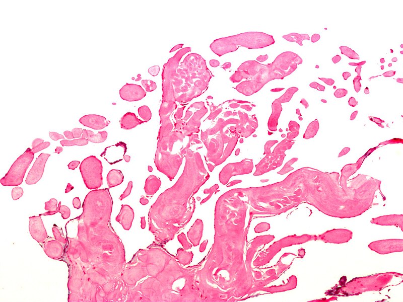 Papillary fibroelastoma