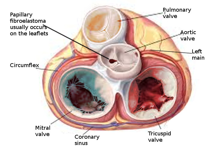 Papillary fibroelastoma