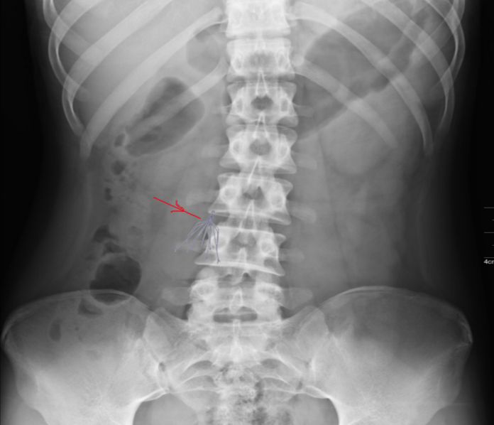 IVC filter: x-ray