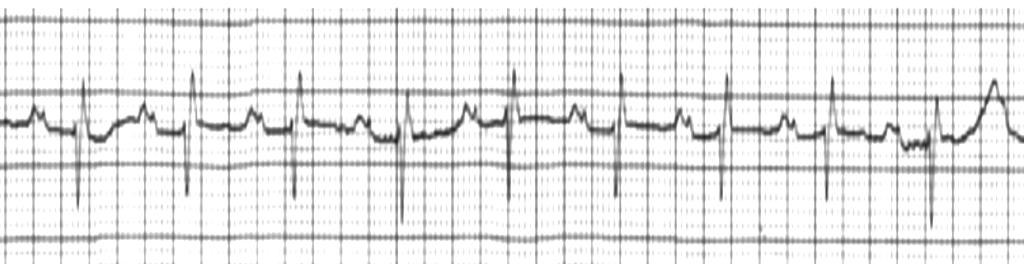 Left atrial enlargement