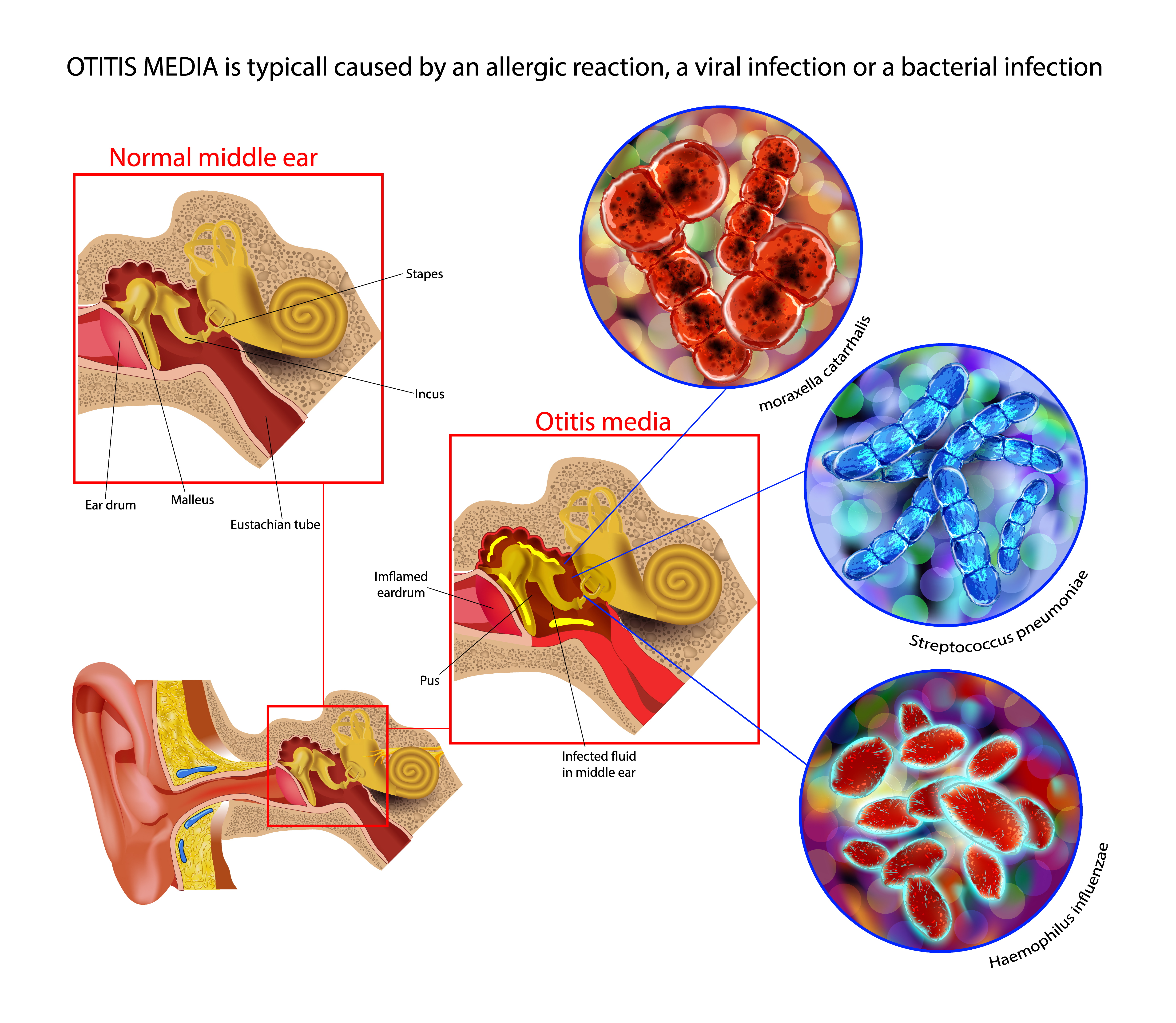 <p>Acute Otitis Media Pathophysiology