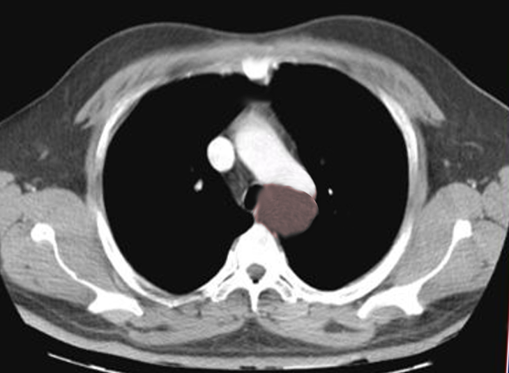 Esophageal cyst