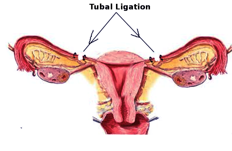 <p>Parkland Tubal Ligation</p>