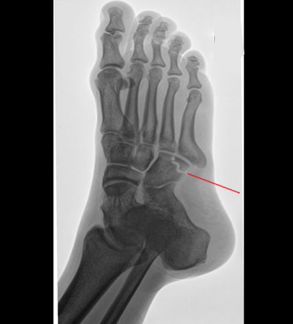 Cuboid fracture