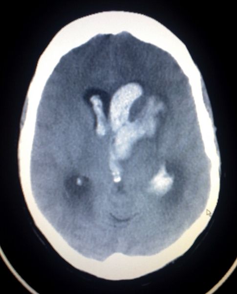 <p>Intracerebral Hemorrhage With Intraventricular Bleeding