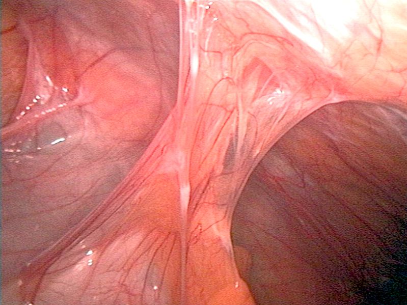 <p>Adhesions to the Abdominal Wall</p>