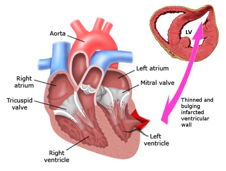 <p>Left Ventricular Pseudoaneurysm</p>