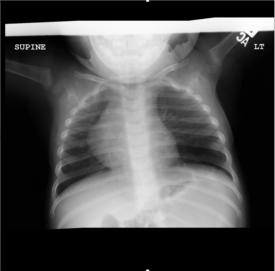 AP view of chest radiograph showing left lower lobe CPAM