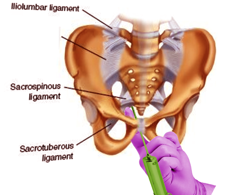 <p>Pudendal Nerve Block