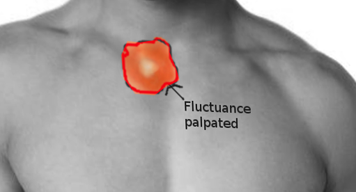 Sternoclavicular joint infection