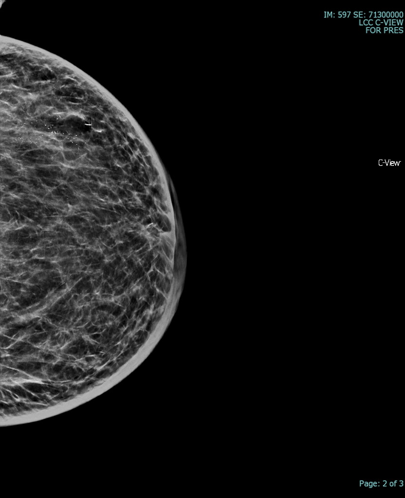 <p>Breast Mammogram