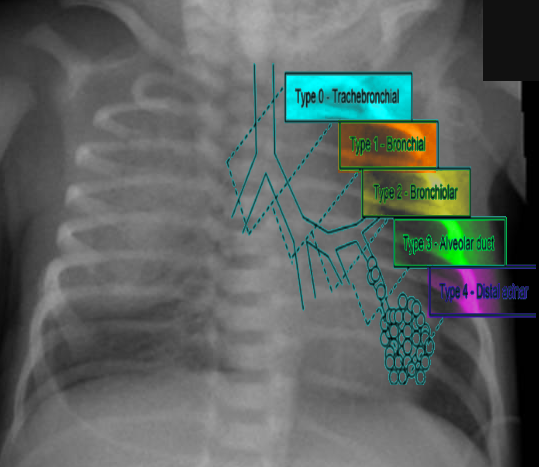 Types of CPAM