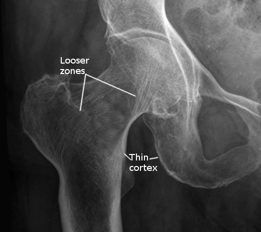 <p>Osteomalacia in Hip Joint, Radiograph. The Looser zones and thin cortex are shown in the radiograph.</p>